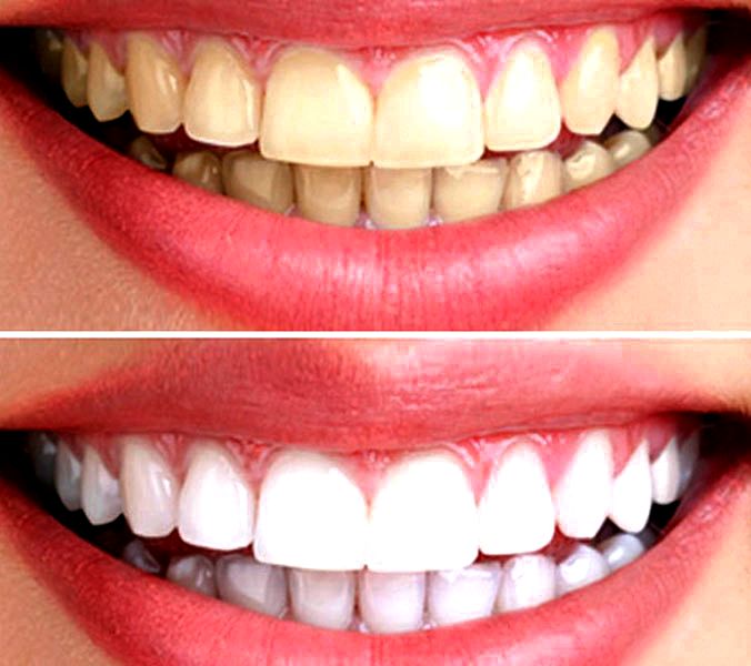 Что такое отбеливание зубов